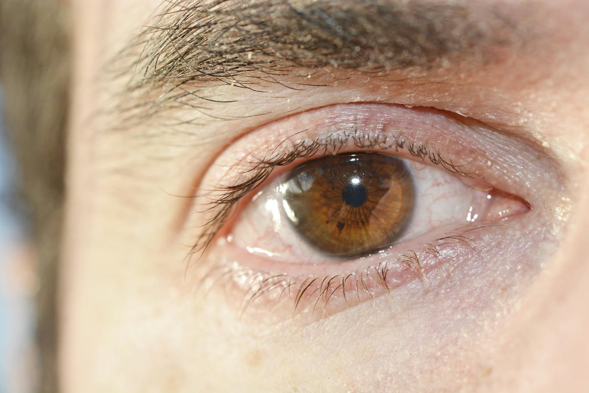 Detailansicht: Zecke Im Auge